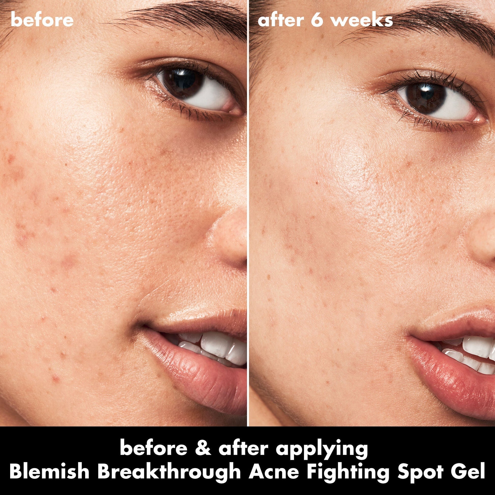 blemish-breakthrough-acne-fighting-spot-gel-f0 0326_EDU_BB_SpotGel_BA_ISABELLA.jpg