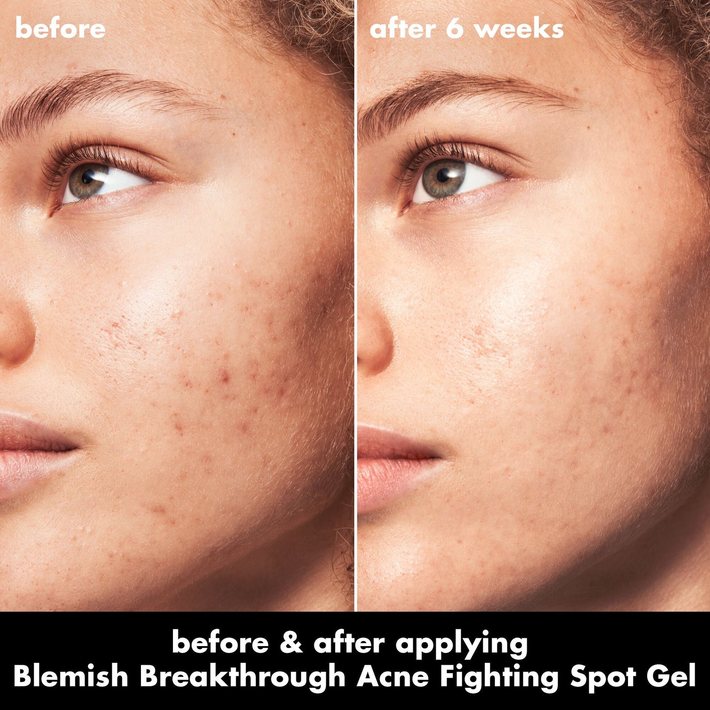 blemish-breakthrough-acne-fighting-spot-gel-f0 0326_EDU_BB_SpotGel_BA_MARLEY.jpg