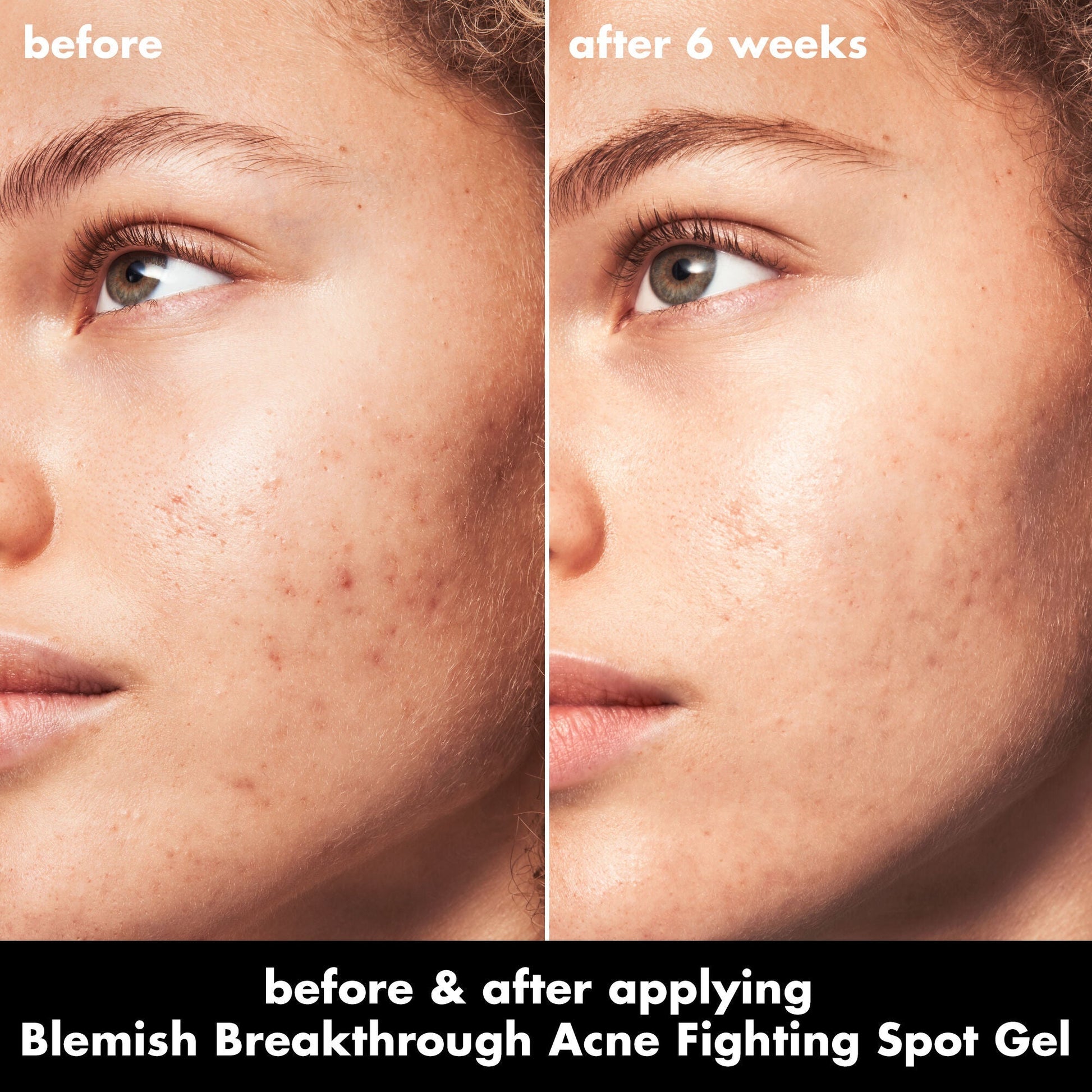 blemish-breakthrough-acne-fighting-spot-gel-f0 0326_EDU_BB_SpotGel_BA_MARLEY.jpg