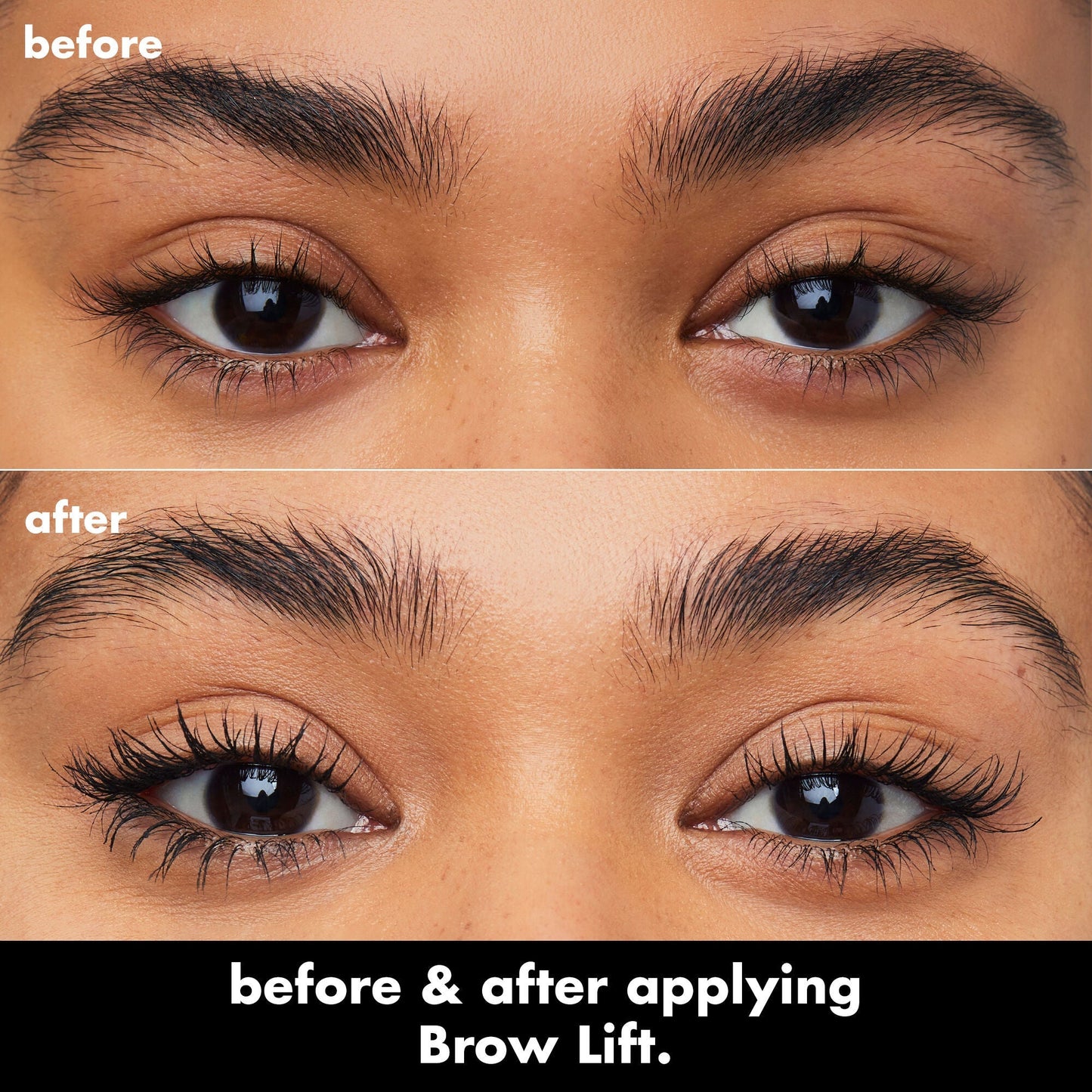 brow-lift-r1 0326_EDU_BrowLift_BA.jpg