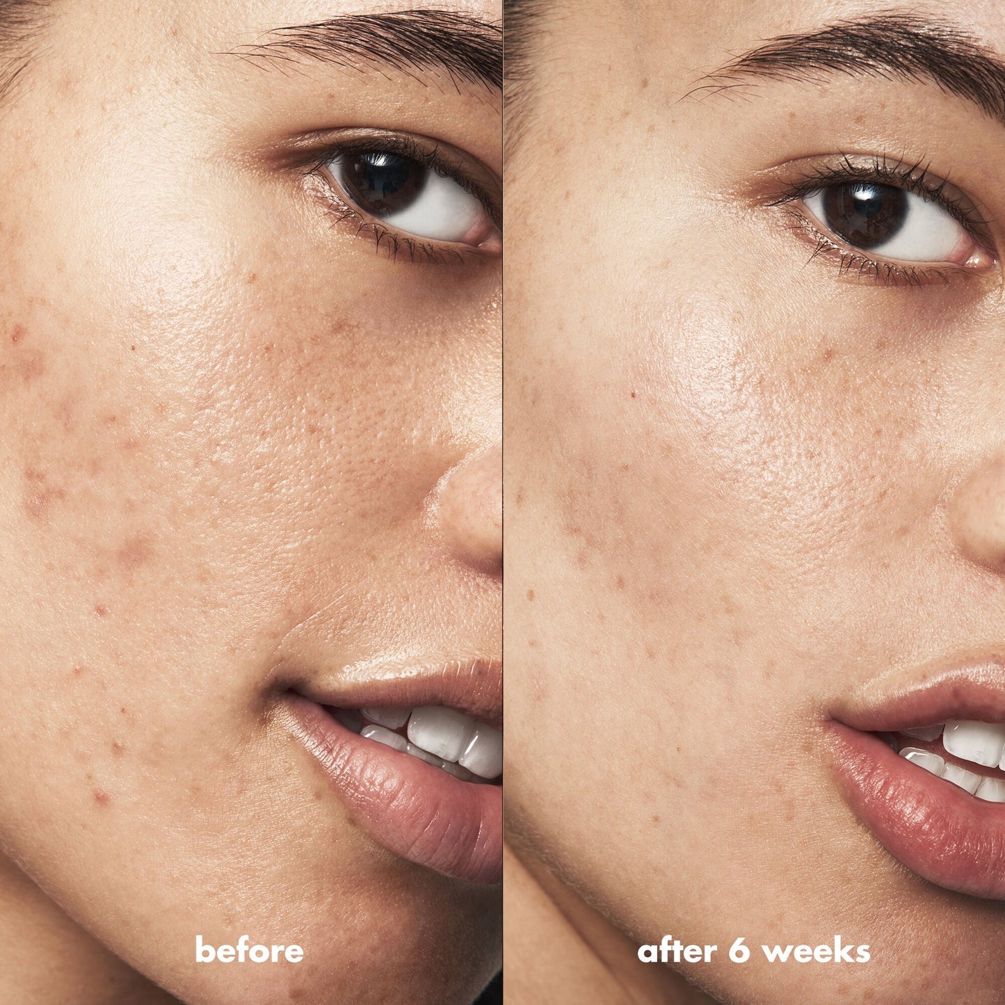 blemish-breakthrough-triple-acid-resurfacing-serum-l2 Acne_PDP_Isabella_Before_After_b8fe0505-ae5c-4baa-9a8e-fd889e4c3414.jpg