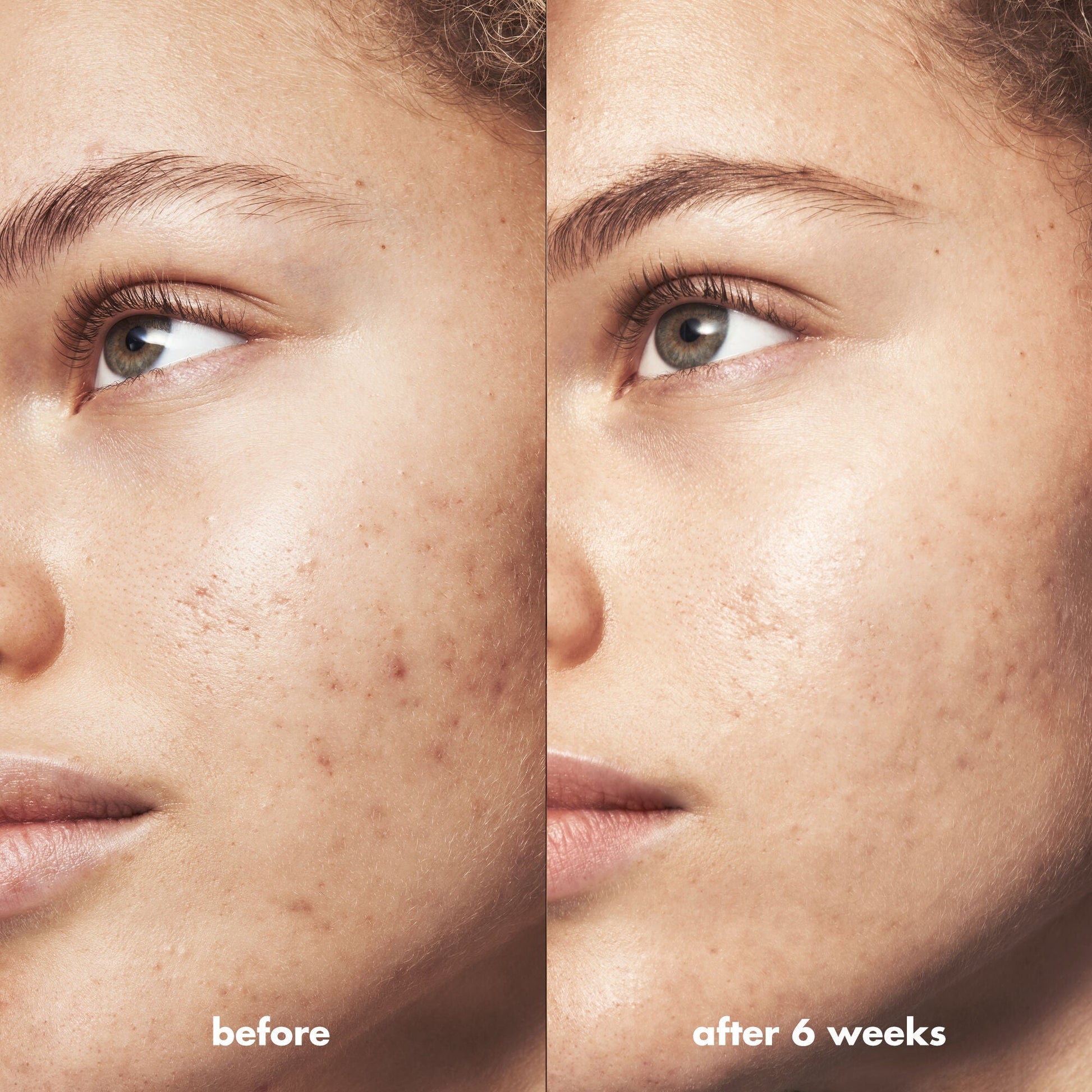 blemish-breakthrough-triple-acid-resurfacing-serum-l2 Acne_PDP_Marley_Before_After_1a95cac5-0af6-43b6-a936-d0bacbdec0bf.jpg